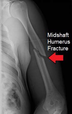 A Long Bone That Is Fractured Midshaft Has Damaged The