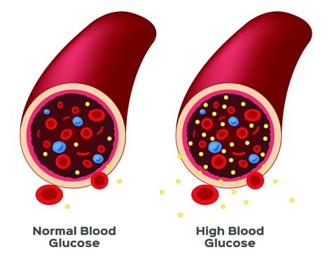 Where Is The Sugar Removed From The Blood